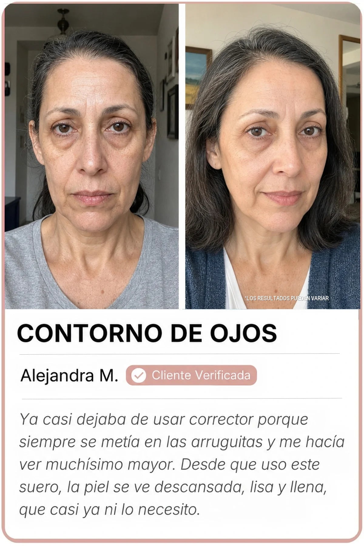 Antes y después Sedanza — Contorno de ojos, Alejandra M.
