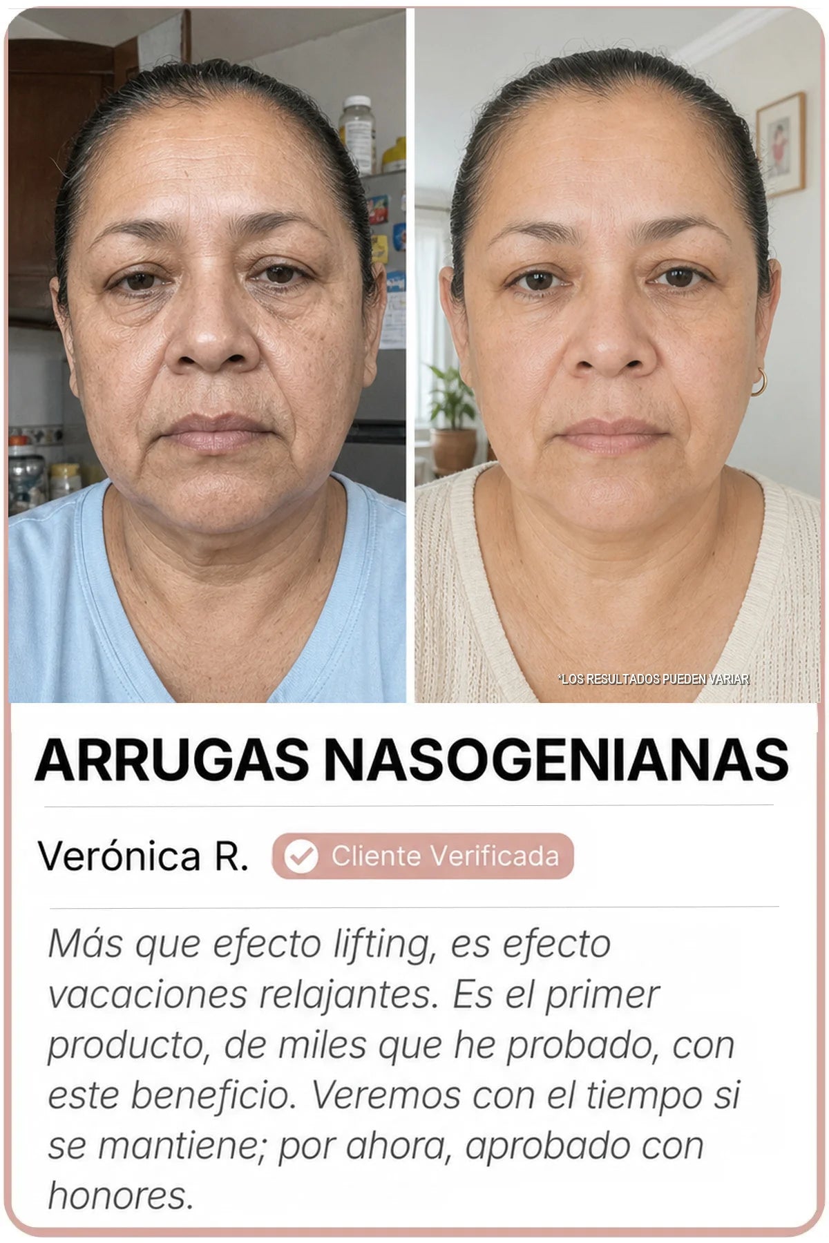 Antes y después Sedanza — Arrugas nasogenianas, Verónica R.