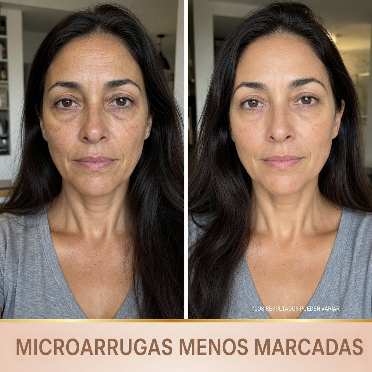 Microarrugas menos marcadas - antes y despues