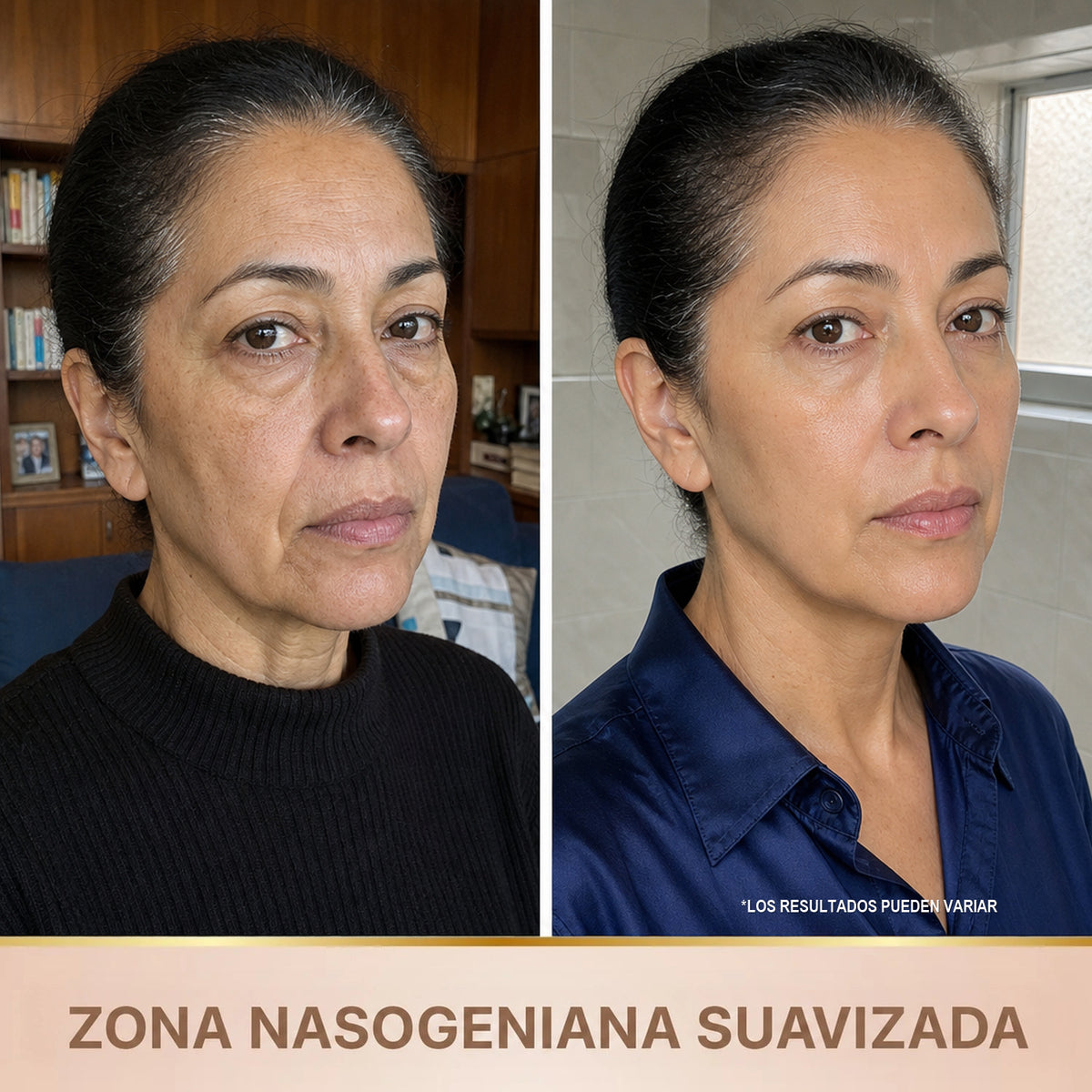 Zona nasogeniana suavizada - antes y despues