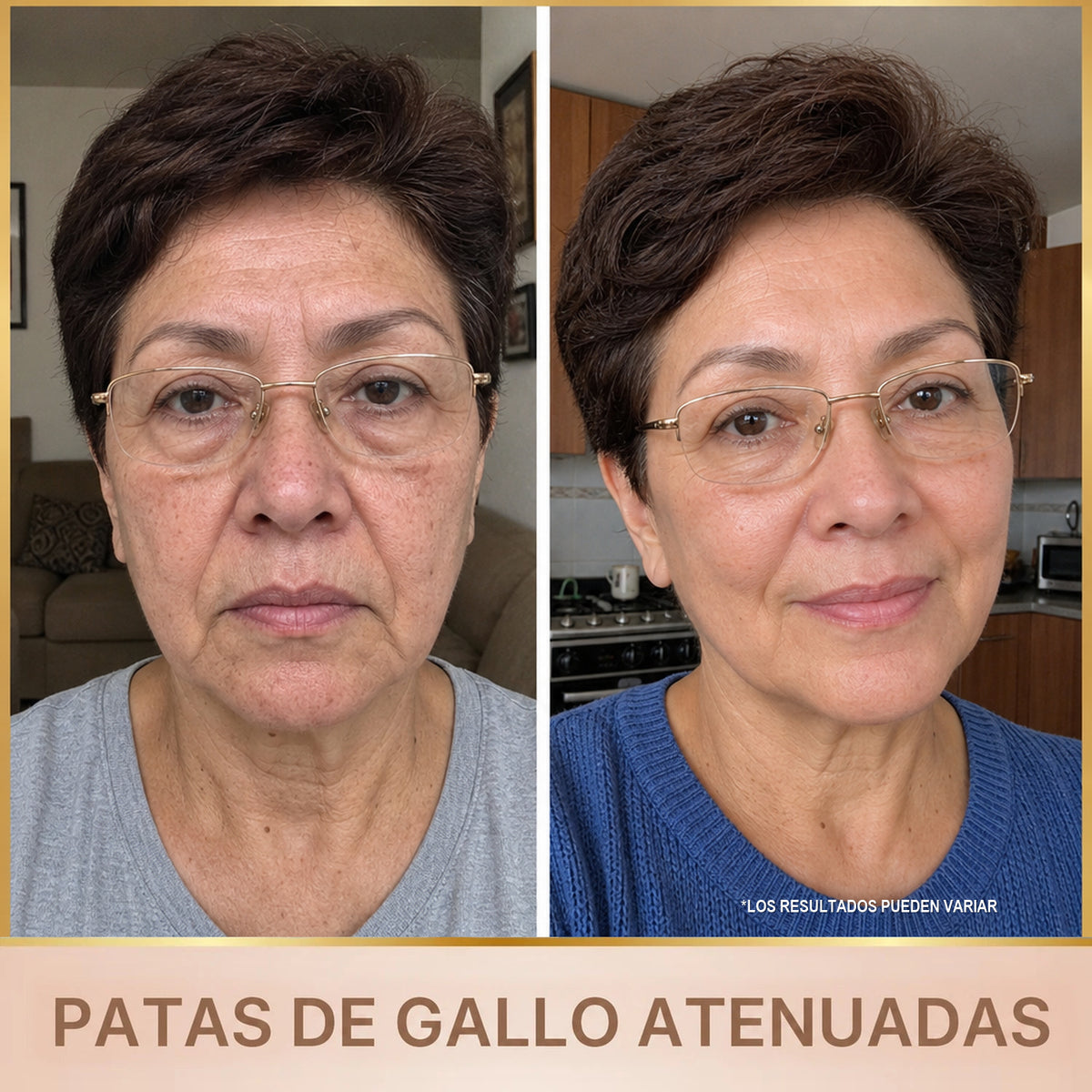 Patas de gallo atenuadas - antes y despues